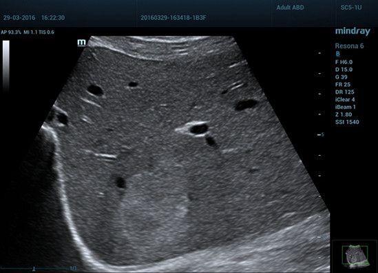 УЗИ аппарат Mindray Resona 6