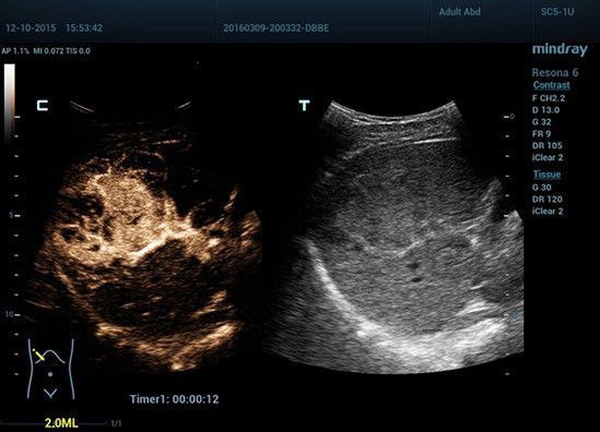 УЗИ аппарат Mindray Resona 6