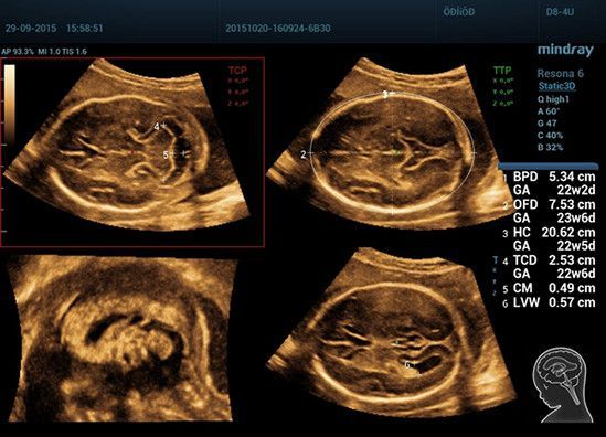 УЗИ аппарат Mindray Resona 6
