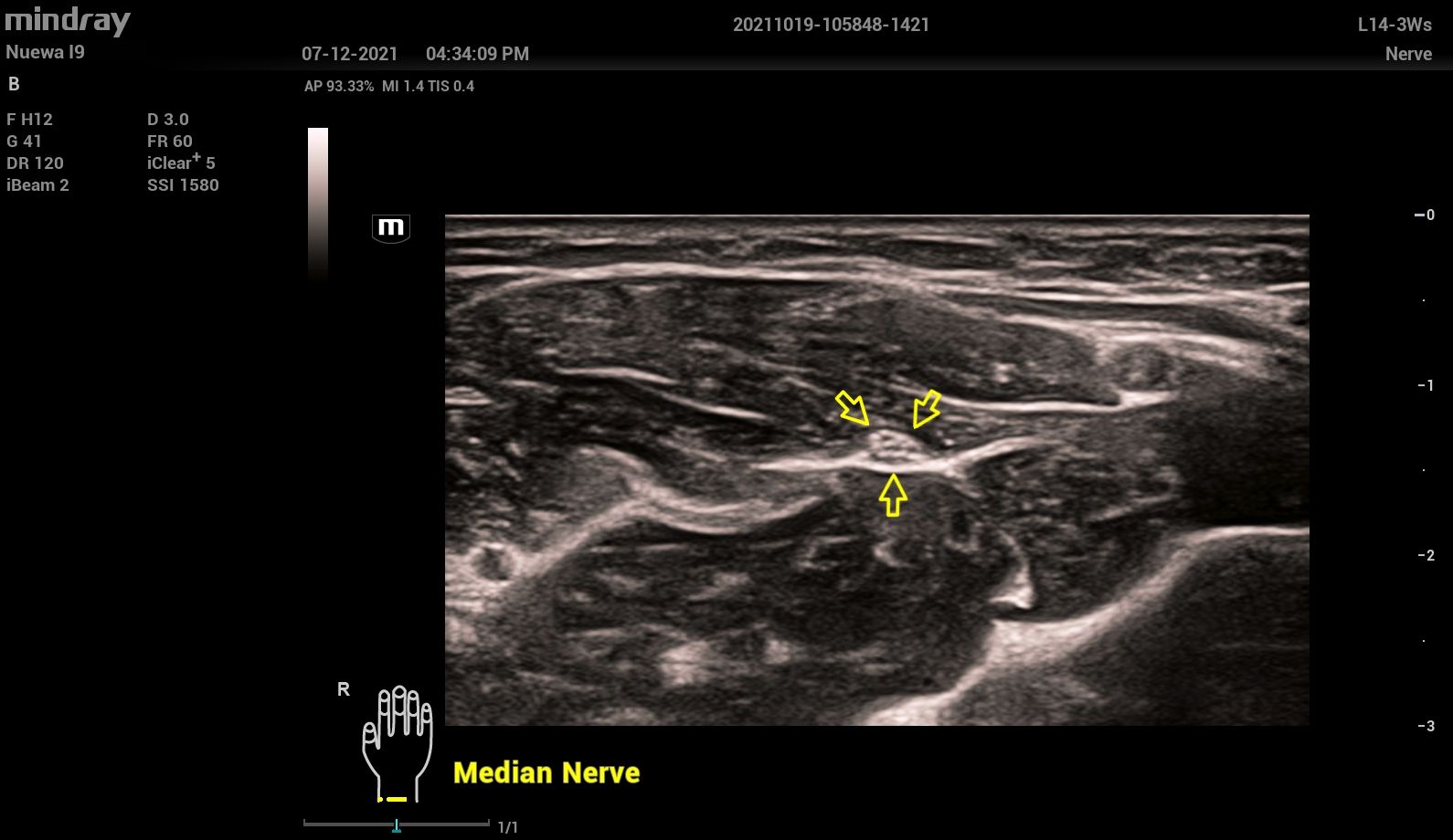 УЗИ аппарат Mindray Resona i9 Exp